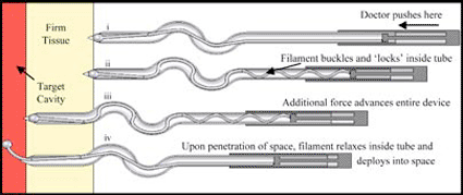 Image: Diagram showing how a new needle developed at MIT works (from top to bottom): i. Doctor pushes here. ii. Filament buckles and 'locks' inside tube. iii. Additional force advances entire device. iv. Upon penetration of space, filament relaxes inside tube and deploys into space (Photo courtesy or Erik Bassett and Jeff Karp).
